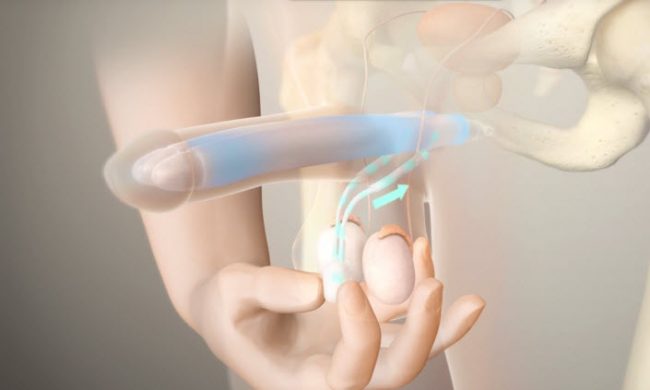 penile-prosthesis